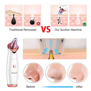 Electric Blackhead Remover